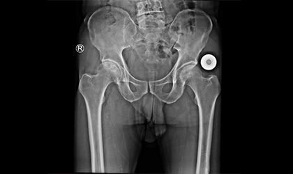 Joint Replacement Case Study