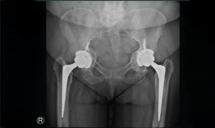 Knee Replacement Case Study