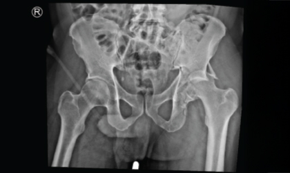 Fracture Dislocation X-ray