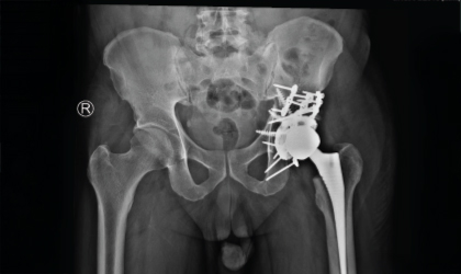 Elderly Hip Fracture Case Study