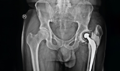 Initial X-ray with Shortened Left Leg