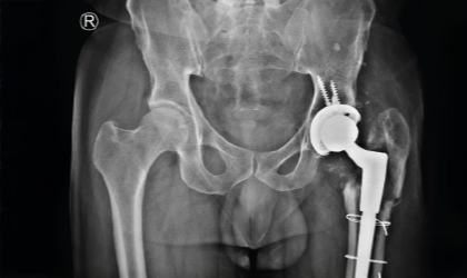 Early Intervention Case Study