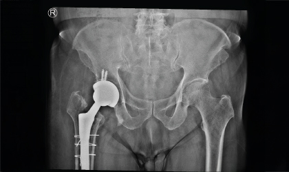 Elderly Patient Post Surgery Walking with Support