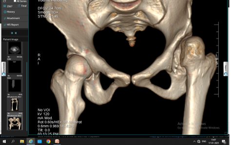 Hip Replacement Case Study